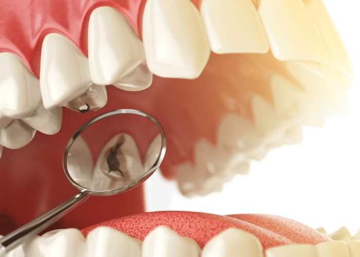 ¿Qué es la caries dental?