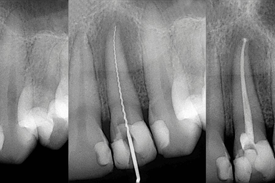 una radiografía dental de una endodoncia